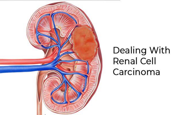 Positive Changes to Help You Deal With Renal Cell Carcinoma - BLK Hospital